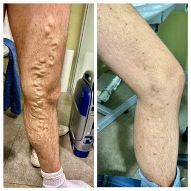 Pierna derecha con venas varicosas y pierna izquierda con apariencia más saludable.